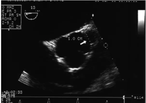 Fig. 1. Left coronary angiogram shows severe eccentric ste- ste-nosis of the ostium of the left main coronary arter(LMC)