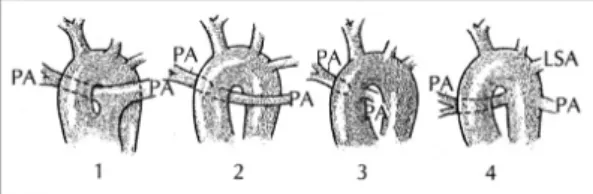 Fig. 8.  33) Classification of truncus arteriosus. Collett-Edwards types 1 to 4. PA=pulmonary artery；LSA=left subclavian artery