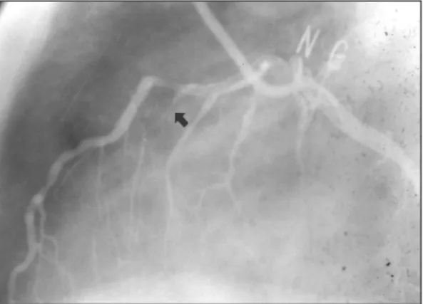 Fig. 1. Left coronary arteriography in the left lateral proj- proj-ection. 증          례 환  자：조○길, 남자, 56세