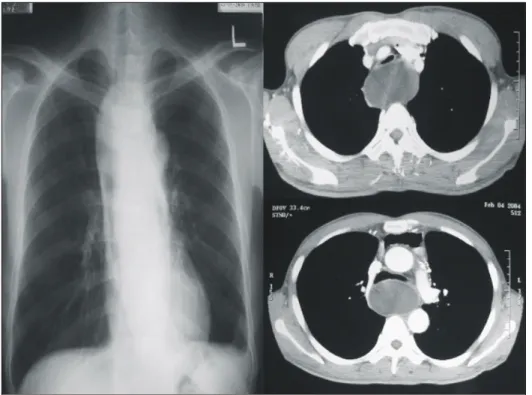 Fig. 2. Chest X-ray and CT  shows that there is large  medi-astinal tumor compress trachea.