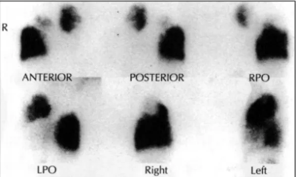 Fig. 1. Perfusion scan shows large perfusion defect in the right upper lobe and left lower lobe