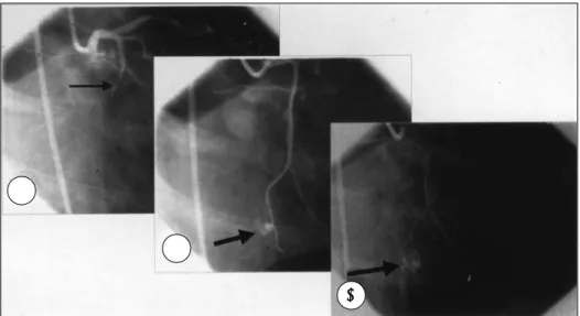 Fig. 1. After successful balloon angioplasty of the total occlusion of proximal left circumflex artery(LCx)(A), persistent contrast agent staining(B &amp; C) was developed at distal LCx after guidewire manipulation