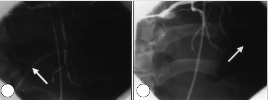 Fig. 6. Follow-up coronary angiograms of one day after the first pericardiocentesis(A) and five days after the second peri- peri-cardiocentesis(B)