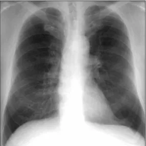 Fig. 3.  Interstitial bronchioles and peribronchiolar parenchyma asso- asso-ciated with mild interalveolar septal scarring and pneumocyte  hyperplasia.