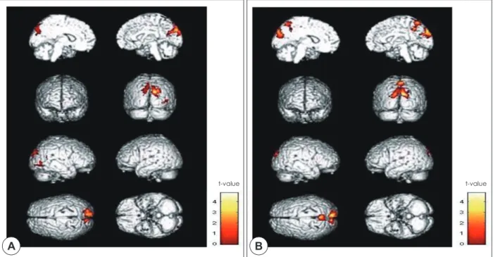 Fig. 2. Brain regions where ASD group showed more activation than HC group. A: In CE vs
