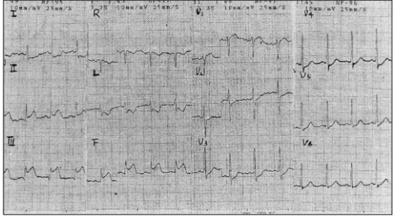 Fig. 1. The electrocardiogram demonstrates ST elevation in leads  Ⅱ,  Ⅲ and aVF. 