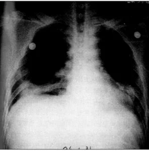 Fig. 3. Technetium-99m SestaMIBI images at rest shows inferior myocardial perfusion defect