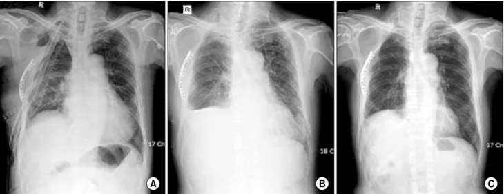 Fig. 1. Postoperative change of thoracic volume with time after concomitant thoracoplasty