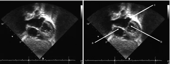 Fig. 3.  Postoperative 2-dimensional echocardiogram at postoperative 9 months showing intact atrial septum (a), no obstruction of left ven- ven-tricular inflow (b) and unroofed coronary sinus (c).