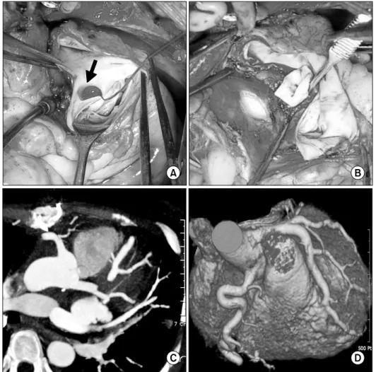 Fig. 3.  Ostium of the left coronary  artery (LCA) from pulmonary artery  open at the left facing sinus (A)