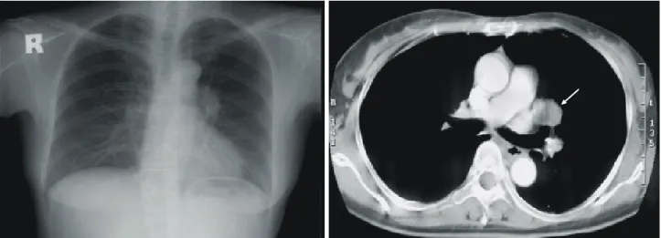 Fig. 2. Chest PA shows partial athelectasis of RLL and chest CT shows a round mass within the right lower lobar bronchus.