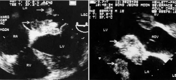 Fig. 5. Brain MRI(T 1 -weighted image) showing multiple lacunar infarctions in the cerebellar hemisphere