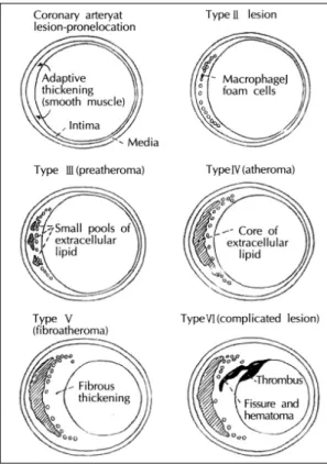 Fig. 3.  죽상경화증의 죽상경화증의 죽상경화증의 죽상경화증의   진행 진행 진행 진행   양상 양상 양상 양상   및 및 및 및   기전 기전 기전 기전 