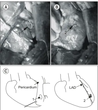 Fig. 3. The defect is repaired with Dacron patch. RV=Right ven- ven-tricle; LV=Left ventricle.