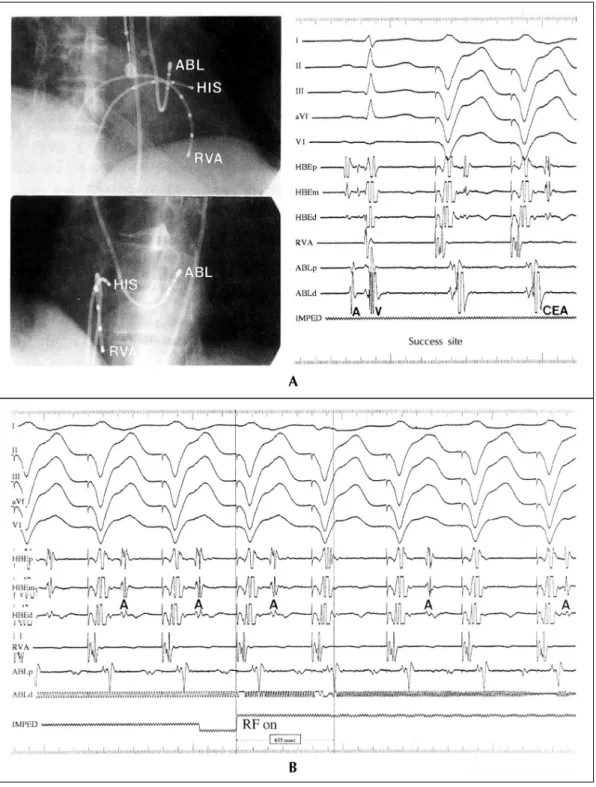 Fig. 1. An example of radiofrequency catheter ablation of a left-side atrioventricular accessory pathway with  no guidance of a coronary sinus electrode catheter