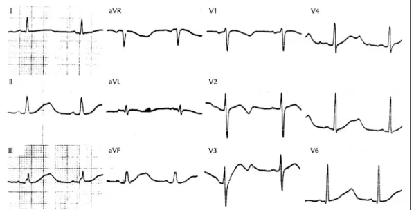 Fig. 1. An electrocardiogram(EKG) on first visiting day. 