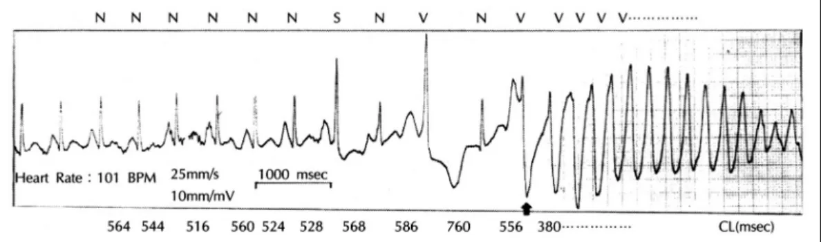 Fig. 3-1. R-R interval prolongation and QT interval shortness in time of torsade de pointes spontainously disappear