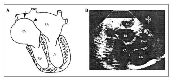 Fig. 2. A：Easiest feature ot recognize the juxtaposed atrial appendages is a curvature of the atrial spptum on 4- 4-chamber views