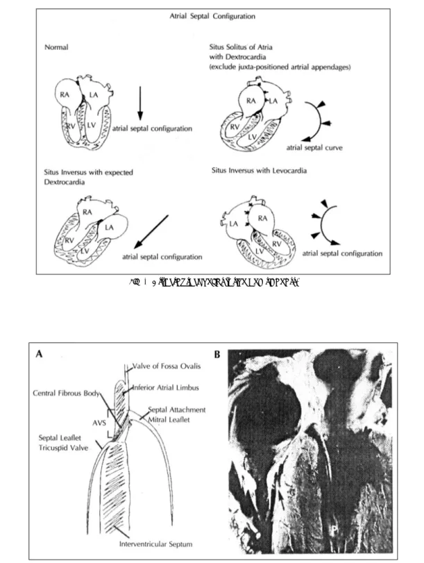 Fig. 3. Atrial septal configuration and sideness. 