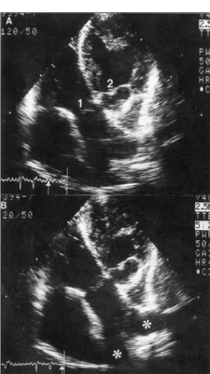 Fig. 8. A：Same patient as in figure 1 and 5. Two great art- art-eries are seen(1, 2). B：By tilting the tranducer,  gr-eat artery located on the left side in the figure(1) bifurcates(*) indicating that this great artery is the pulmonary artery