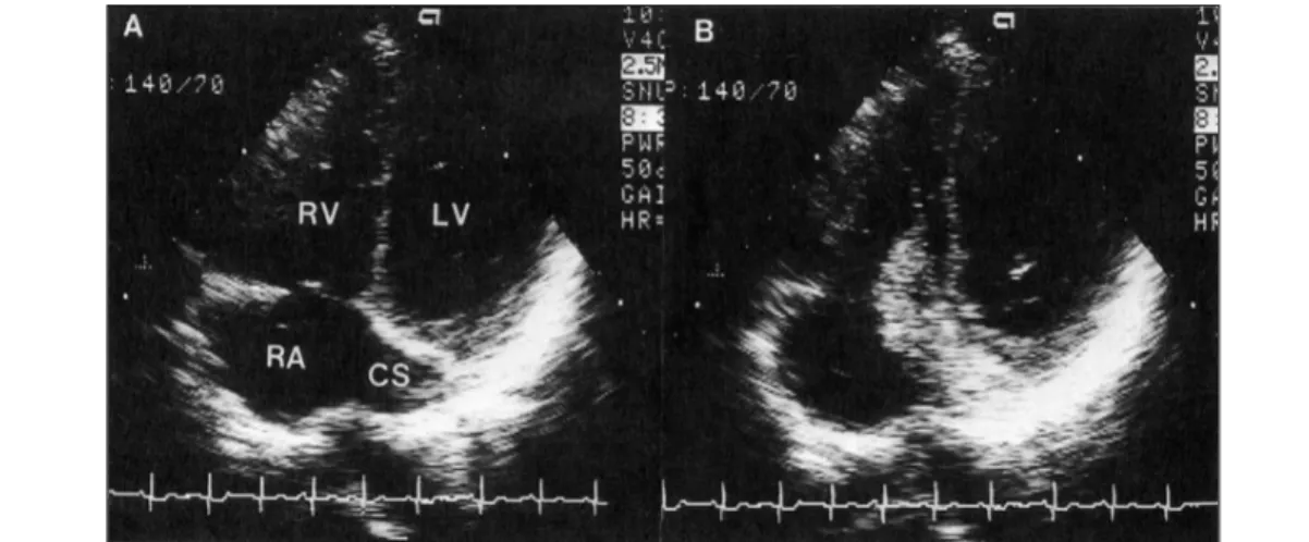 Fig. 12. A：Coronary sinus could be visualized by slightly tilting the transducer downward at the apical 4-chamber  view