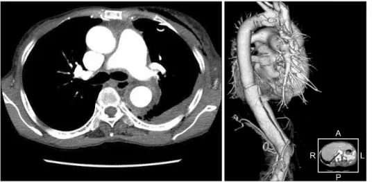 Fig. 2. Postoperative CT scan and  3D reconstruction. Hematoma surround  the false lumen and left lung was  lost