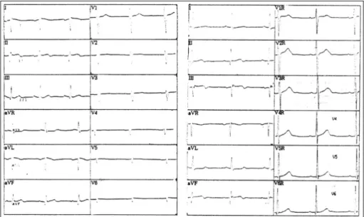 Fig. 3. Right coronary angiogram(Left：pre-PTCA, right：post-PTCA). 