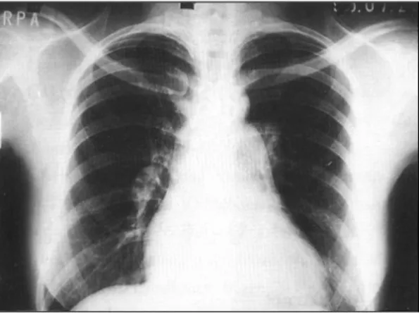 Fig. 2. Electrocardiogram shows sinus rhythm with right ventricular hypertrophy. 