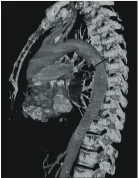Fig 4. Resected bronchial artery aneurysm-It was pulsatile and  7×5 cm sized, and central thrombosis and calcification (arrow)  are seen.