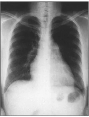Fig. 1. Chest PA showing slightly increased heart size and bulging of right cardiac border and  pulm-onary conus but no active lesion in both lung parenchyme