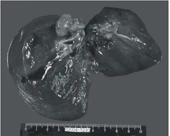 Fig. 3. Bronchoscopy: well demarcated endobronchial mass in  right intermediate bronchus.