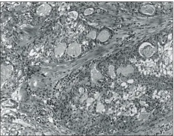 Fig. 5. The tumor shows a combination of well differentiated mucous cells, intermediate cells, and focal squamous cells