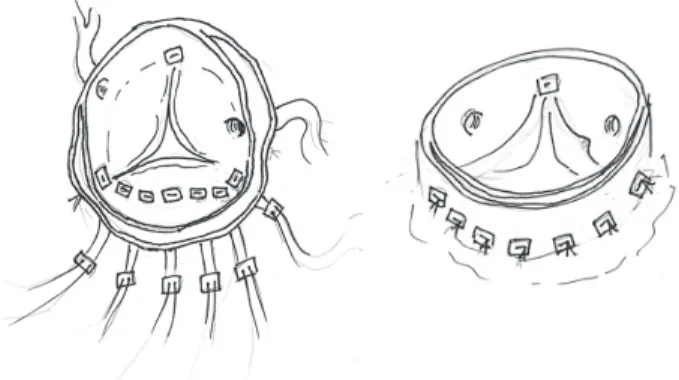 Fig. 3. Shematic drawings of aortic root plasty. The fixating  interrupted horizontal mattris sutures of pledged 5-0 prolene  were  placed around the displaced annulus and commissures.