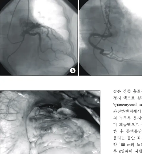 Fig. 2. Operative photograph after longitudinal opening of the  pericardium shows bilateral coronary to pulmonary artery  fis-tulas