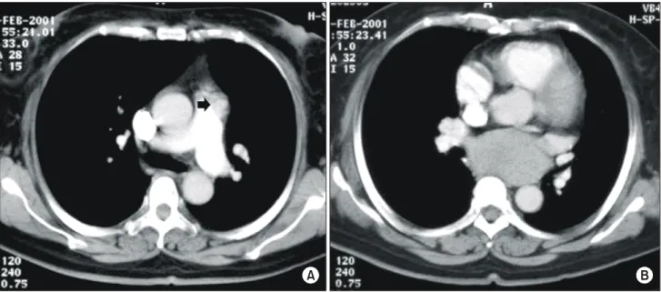 Fig. 3. Chest CT scan showed dilated and tortuous fistulas tract (black arrow) ending anterior aspect of the main pulmonary  artery  (A) and subcarinal large cystic mass (B).
