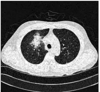 Fig. 1. Chest computed tomographic scans at the level of the carina demonstrating an air crescent sign