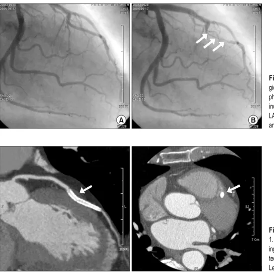 Fig. 1. Preoperative coronary an- an-giogram of case 1. (A) In diastolic  phase, (B) In systolic phase