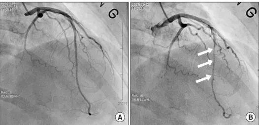 Fig. 3. Preoperative coronary angio- angio-gram of Case 2. (A) In diastolic  phase, (B) In systolic phase