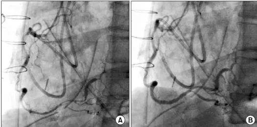 Fig. 3. The significant spasm is seen on entire right coronary artery (A). 