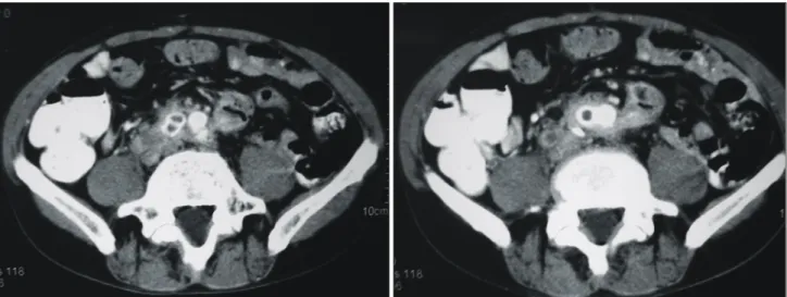 Fig. 2. Postoperative CT angiopraphy. The vein graft shows 