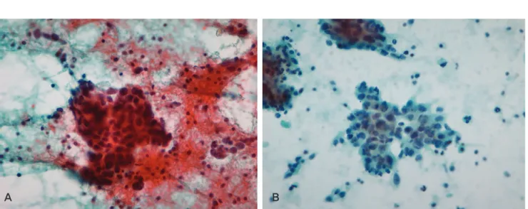 Fig. 2. Cytomorphology in a case of ductal carcinoma. Comparing with conventional smears (A), the Liqui-PREP ™(B) shows lack of obscuring background(RBC) and overlapping of cells