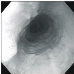 Fig. 1. Endoscopic finding show that mucosa was nodularity  and elevation in lower esophagus.