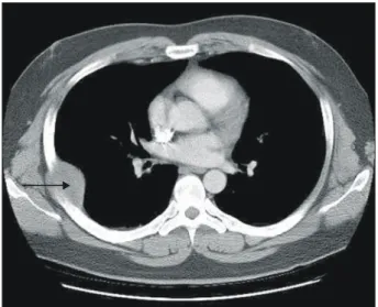 Fig. 2. Chest CT scan shows 5.5 cm sized relative well  defined soft tissue mass (arrow) in right 5th and 6th rib area  without lung  parenchymal lesion
