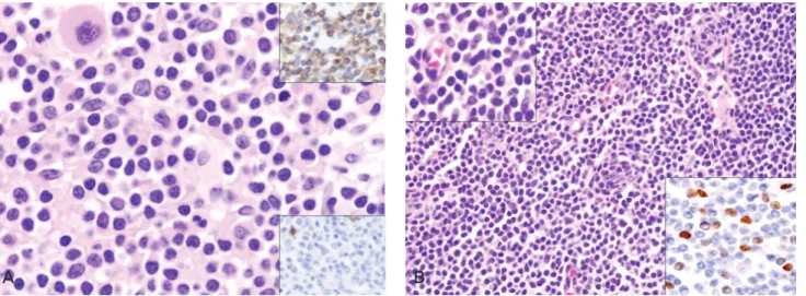 Fig. 3. Bone marrow and inguinal lymph node biopsy: (A) The bone marrow biopsy demonstrates lymphoid cells showing nuclear atypical and irregular nuclear contour with occasional convolution and small nucleolus