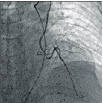 Fig. 1. Patient with incisional wound after MIDCAB. The length of the wound is about 7 cm longitudinally