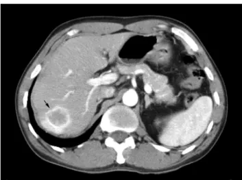 Fig. 1. Computed tomography of the liver. Computed tomog- tomog-raphy shows a well demarcated tumor with peripheral contrast enhancement (arrow)