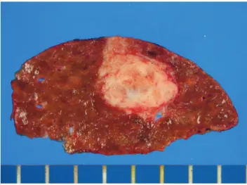 Fig. 3. Gross finding. Tumor shows a well circumscribed gray- gray-white solid cut surface