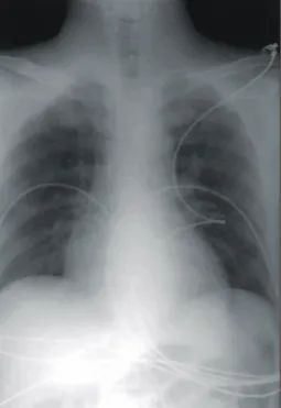 Fig. 3. Communicating hole and vegetation of noncoronary  sinus.