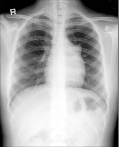 Fig. 1. Chest roentogram shows horn like projection of left atrium.