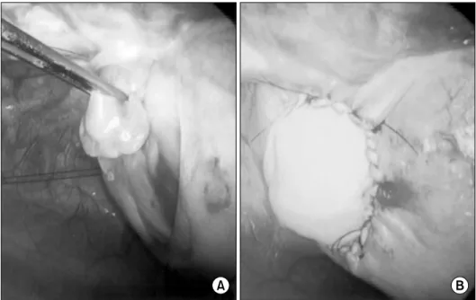 Fig. 3. (A) This picture shows par- par-tial pericardial defect and hernation  of left atrial appendage